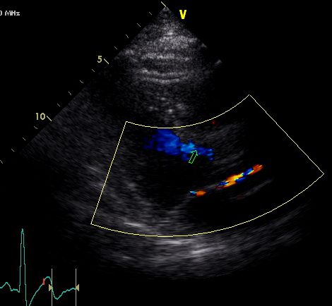 Color Doppler parasternal long axis view of the left ventricular outflow tract 