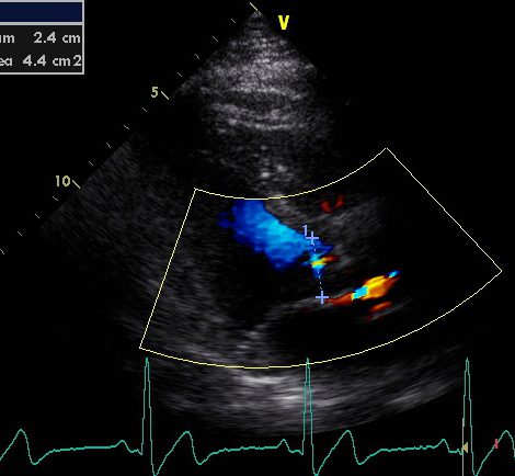 Color Doppler parasternal long axis view with measurement of the left ventricular outflow tract 