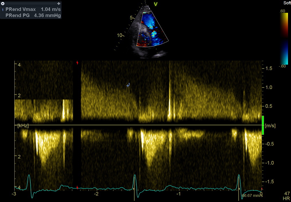 Figure 24. Continuous wave Doppler, pulmonary regurgitation