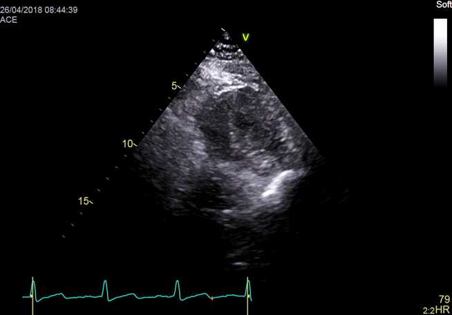 Figure 28. 2D parasternal short axis, left ventricular apex