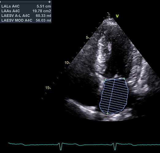 Figure 38. 2D apical 4-chamber view, optimized for left atrium