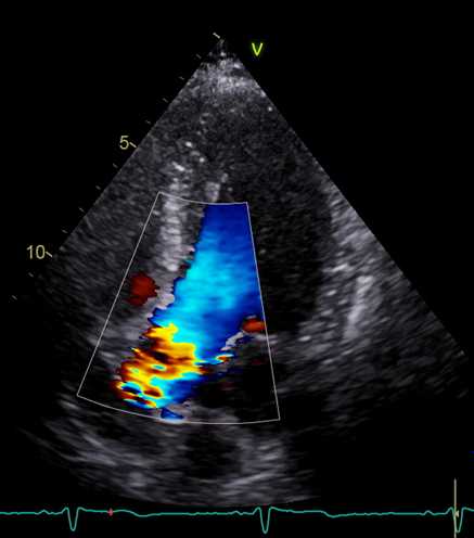 Figure 49. Color Doppler apical 5-chamber view