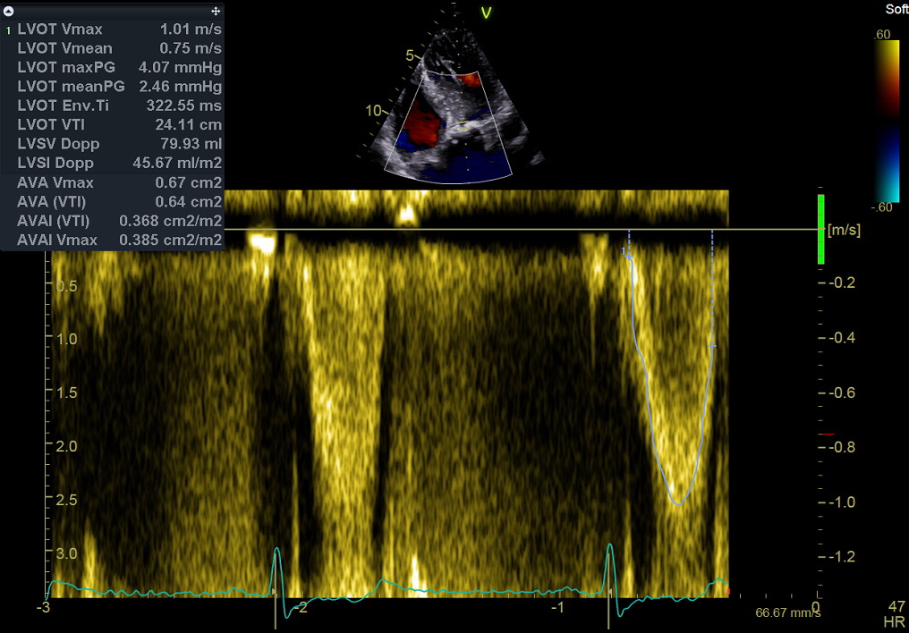 Figure 50. Pulsed Doppler, left ventricular outflow