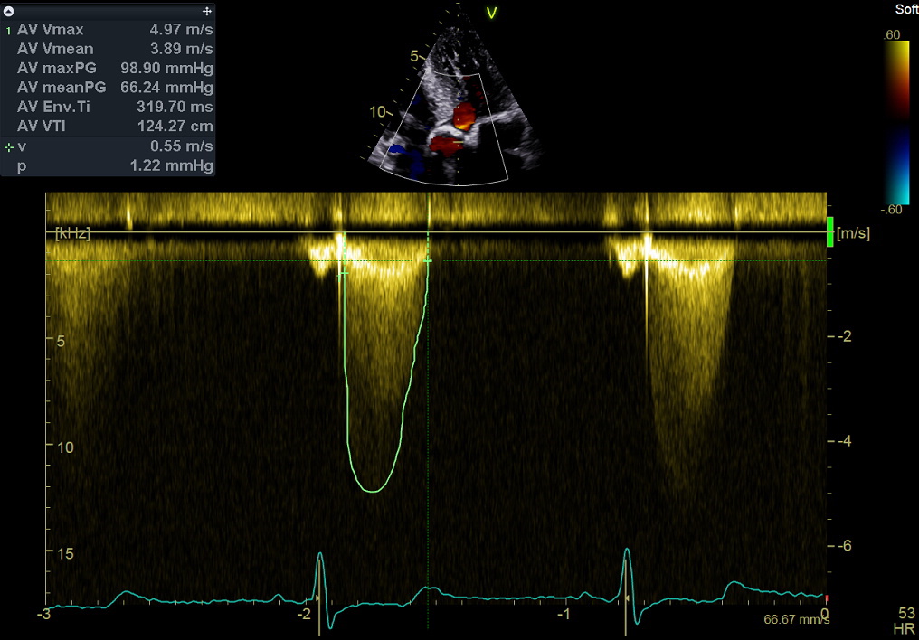 Figure 51. Continuous wave Doppler, aortic valve
