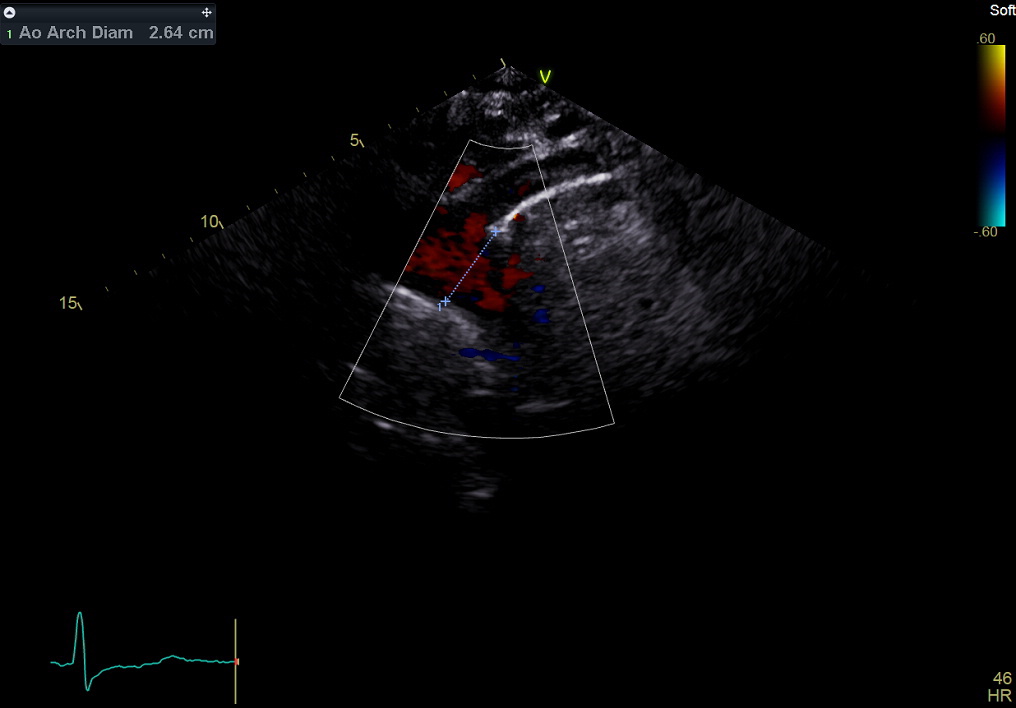 Figure 61. Color Doppler, suprasternal aortic arch
