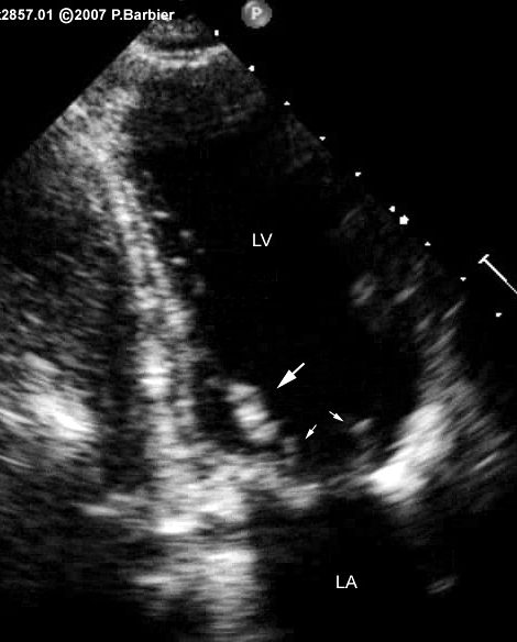Clinical example of preserved mitral valve chordae during mitral valve replacement