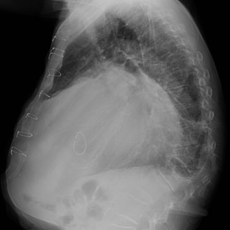 Chest Xray of massive left atrial dilatation (lateral view)