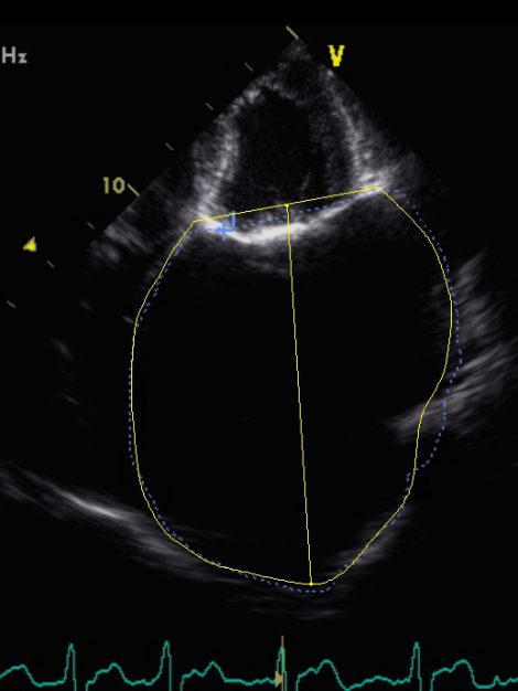 Transthoracic apical 4-chamber view with measurement of the left atrium