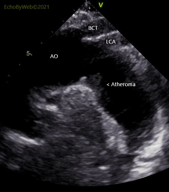 Figure 2. 2d jugular long axis aorta 图2. 2d 颈动脉长轴主动脉. Atheroma of aortic arch. 