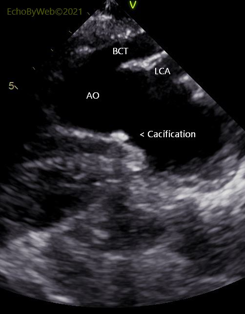 Figure 3. 2d jugular long axis aorta 图3. 2d 颈动脉长轴主动脉. Calcification of aortic arch