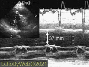 Figure 3B. M-mode measure of severely abnormal mitral valve E-septal separation