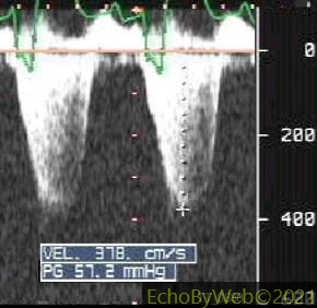 Figure 5. Continuous wave Doppler of mitral regurgitation in left ventricular systolic dysfunction