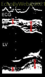 Figure 8. M-mode left ventricular measurements