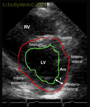 Figure 1. 2D parasternal short axis of the left ventricle. Measurement of myocardial area