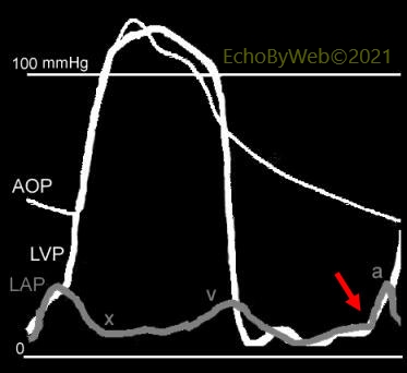Figure 1. Left ventricular and left atrial pressures tracings