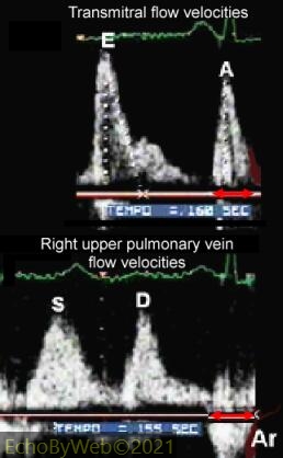 Figure 2. Pulsed Doppler transmitral and pulmonary venous flow velocity profiles. 