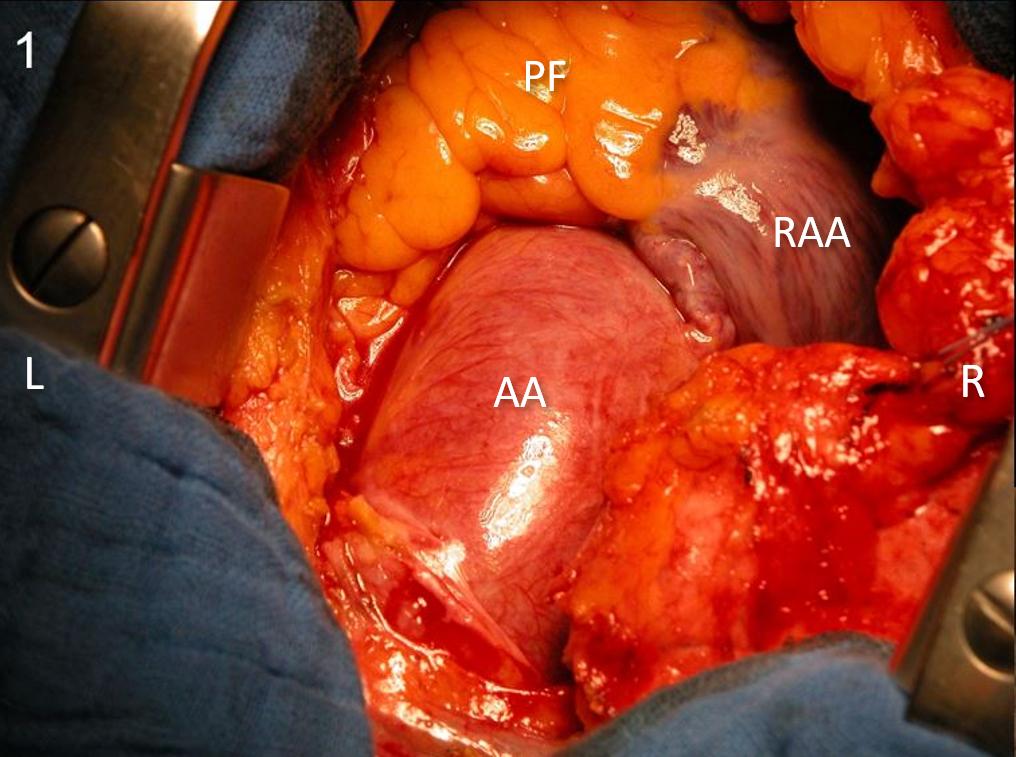 Figure 10. Intraoperative anatomy pictures, before aorta clamping