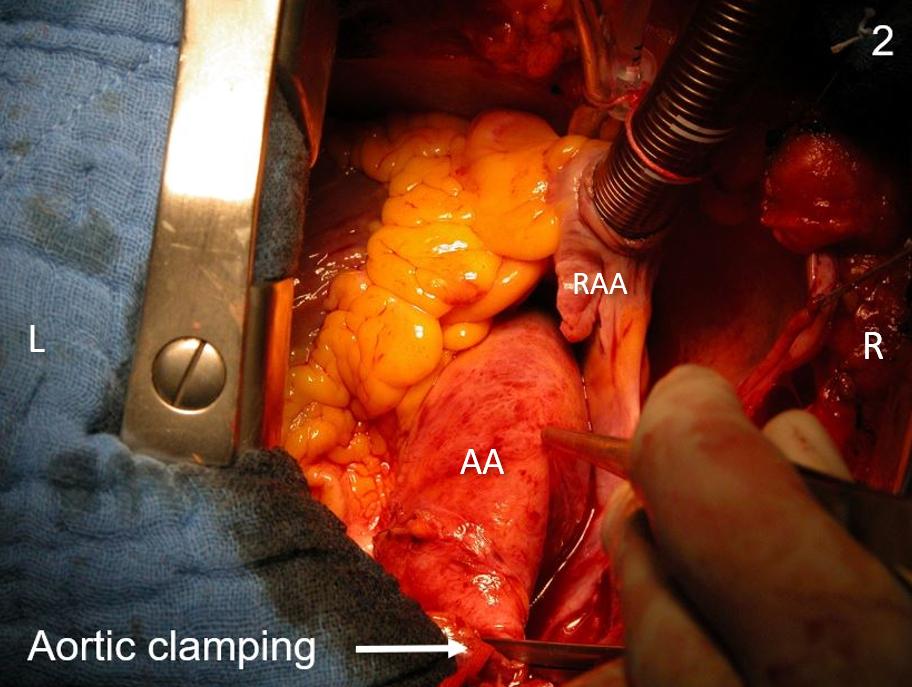 Figure 11. Intraoperative anatomy pictures, aortic clamping