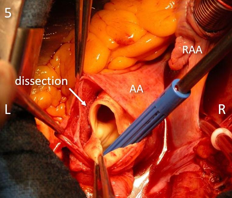Figure 14. Intraoperative anatomy pictures, dissection visible