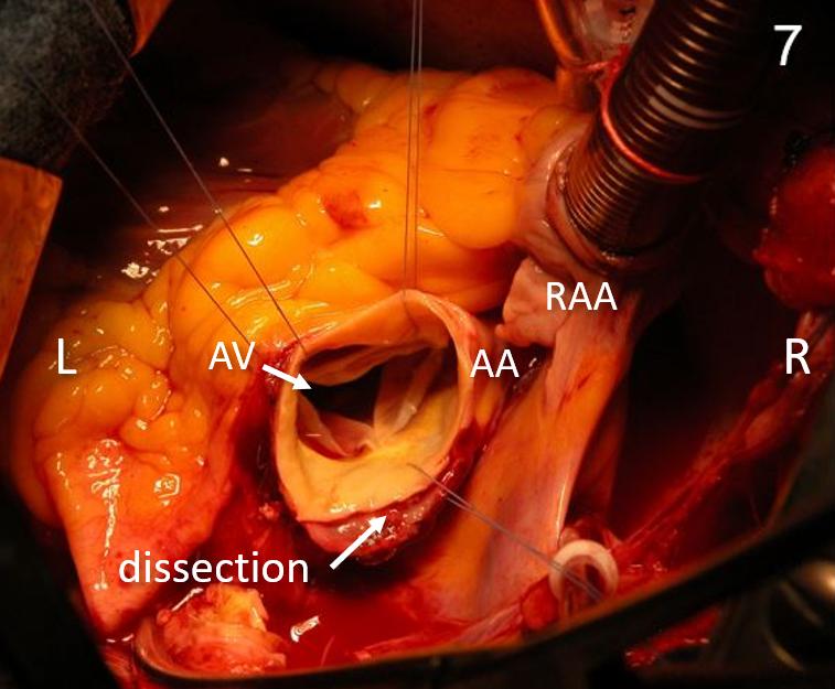 Figure 16. Intraoperative anatomy pictures, dissection visible