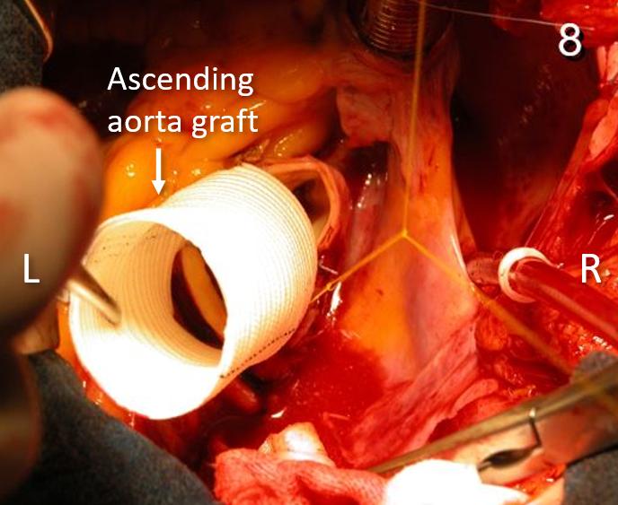 Figure 14. Intraoperative anatomy pictures, positioning of ascending aorta graft