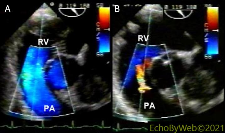 Figure 3. Transesophageal examination, Long axis (119°) of the base, color Doppler flow imaging of pulmonary regurgitation