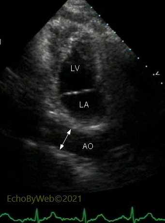 2D measurement of descending thoracic aorta