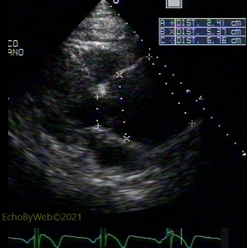 Figure 6. 2d parasternal long axis ascending aorta 图6. 2d胸骨旁长轴升主动脉. Aneurysm. 