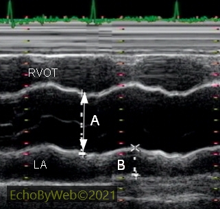 M-mode moderate to severe dilatation of the aortic root