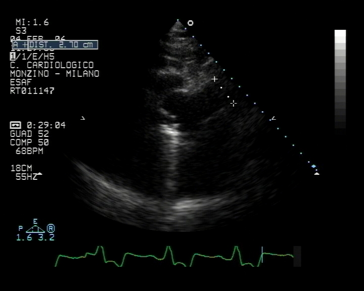Figure 5. 2d measurement ascending aorta 图5. 升主动脉2d测量