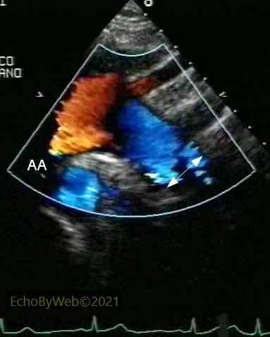 Measurement of aortic arch with aid of color Doppler