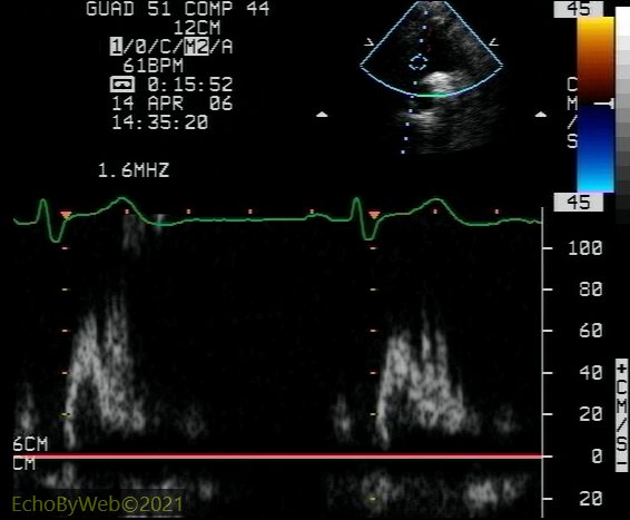 Figure 3. Pulsed Doppler beginning of aortic arch 图3. 脉冲多普勒主动脉弓起点 Normal aortic arch. 