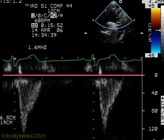 Figure 4. Pulsed Doppler distal aortic arch 图4. 脉冲多普勒主动脉弓远端. Normal aortic arch. 
