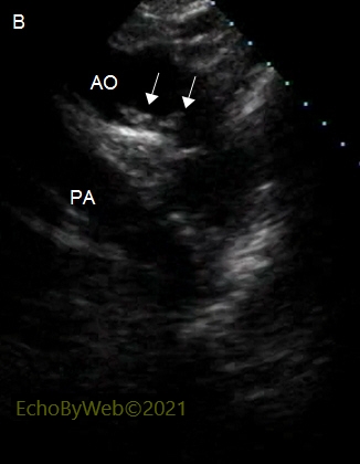 Multiple aortic arch atheromas