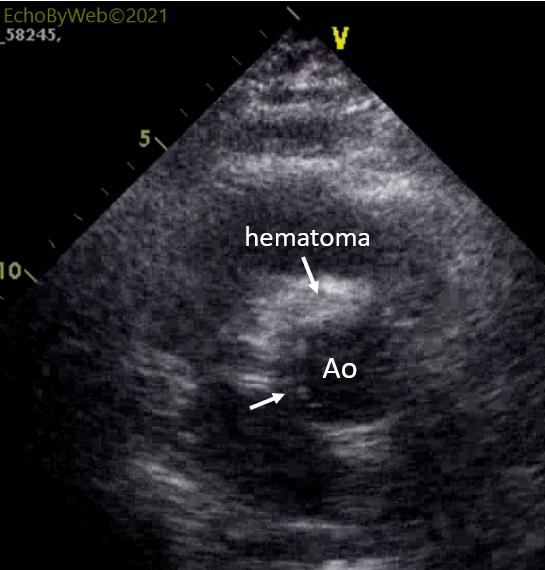 Figure 5: 2d parasternal short axis aorta 图5: 2d胸骨旁短轴主动脉. Hematoma of the wall