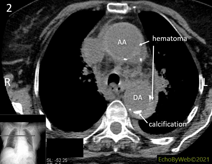 Figure 7. Chest CT scan, no contrast 图7. 胸部CT扫描，无造影剂