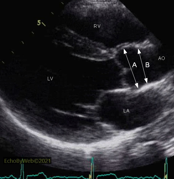  A normal 2D exam of the aorta