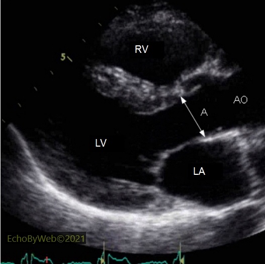 Measurement of normal aortic valve annulus