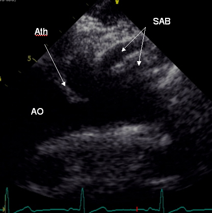 Figure 4. Ath: atheroma; SAB: supra-aortic branches 图4. Ath: 动脉粥瘤; SAB: 主动脉上分支. 