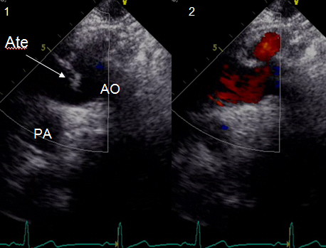 Figure 6. Ath: atheroma Ath: 动脉粥瘤. Atheromas of the aortic arch. 
