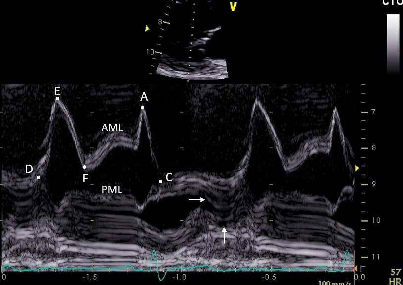 Figure 2 M-mode mitral valve 图2 M型二尖瓣, end-systolic prolapse