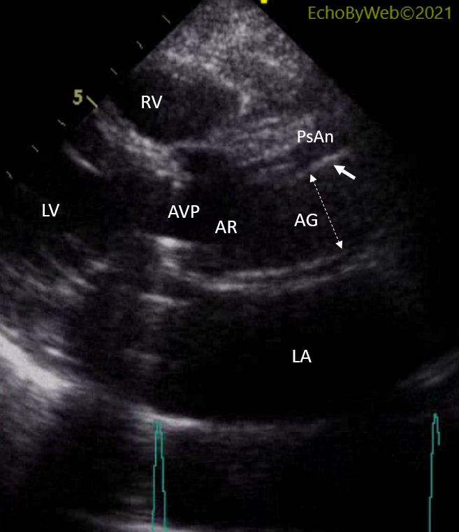 Figure 2. 2d parasternal long axis aortic root & aorta 图2. 2d胸骨旁长轴主动脉根及主动脉. Pseudoaneurysm.