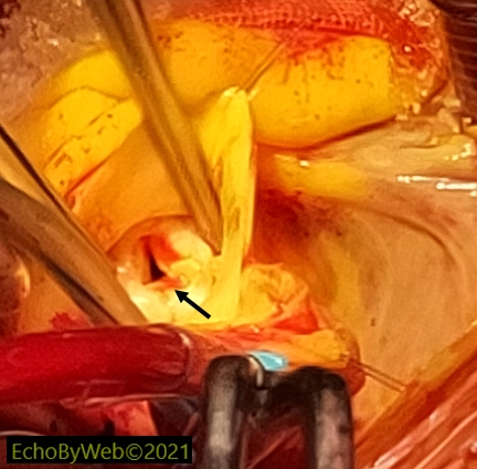 Figure 8. Intraoperative image of the aortic valve 图8. 术中主动脉瓣