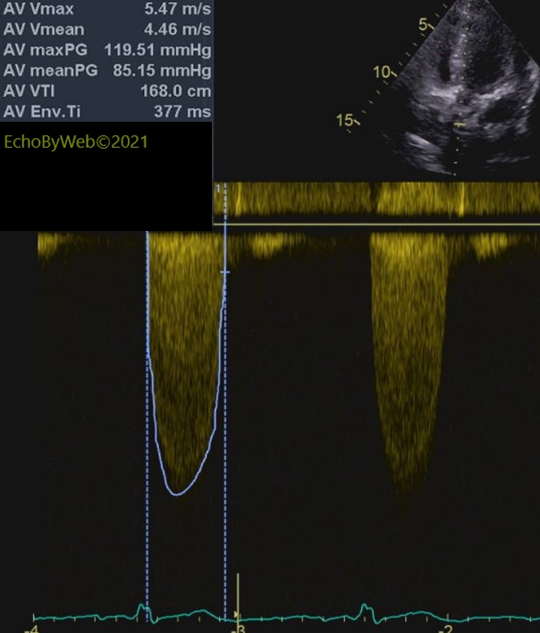 Figure 6. CW apical 5-chambers AV 图6. 彩色多普勒心尖5腔图主动脉瓣. Severe aortic valve stenosis