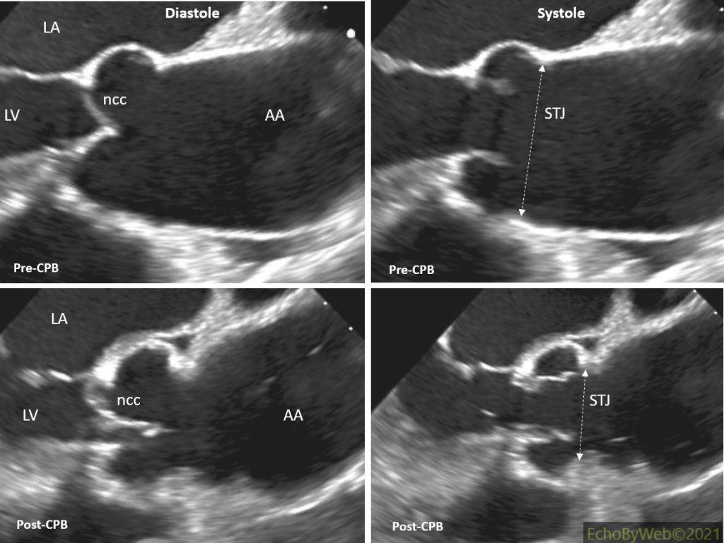 Figure 4. 2D upper esophagus long axis AV, 146 deg. Pre and post surgery images of the aortic valve