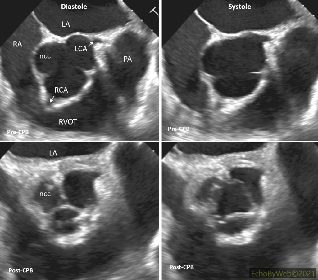 Figure 7. 2D upper esophagus short axis AV. Pre and post-CPB imaging of the aortic valve.