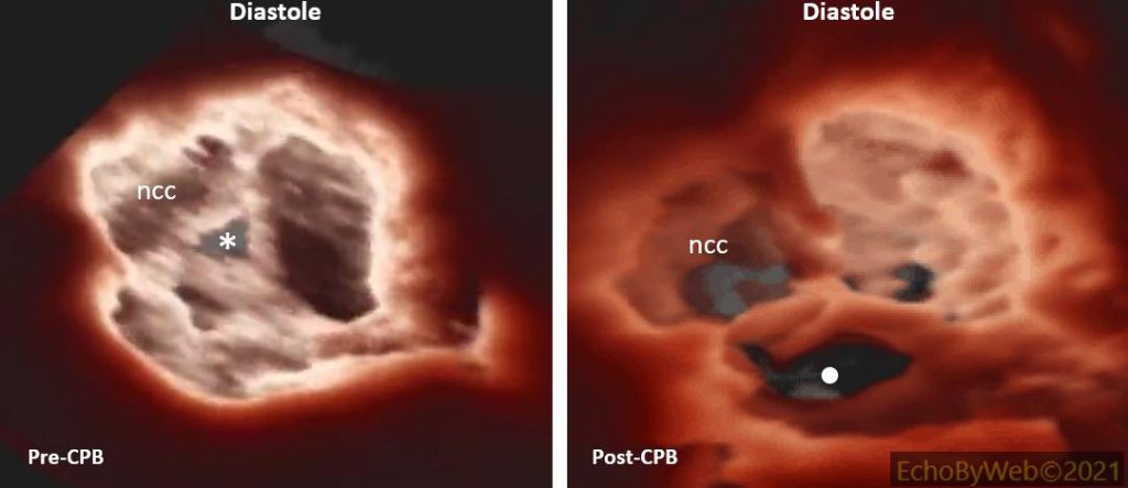 Figure 10. 3D short axis AV. Pre- and post-CPB. 3D imaging (from the aorta) of the aortic valve