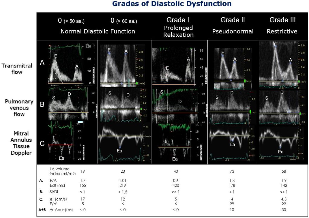 Figure 5. Real-life examples of diastolic dysfunction grades.