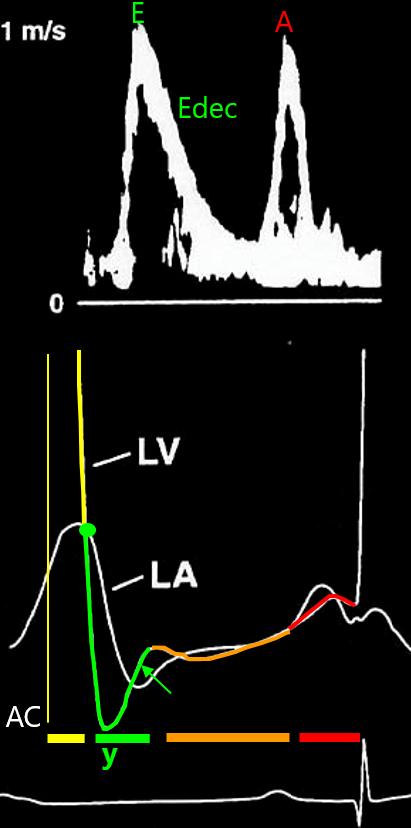 Figure 6b, The LA-LV pressure gradient