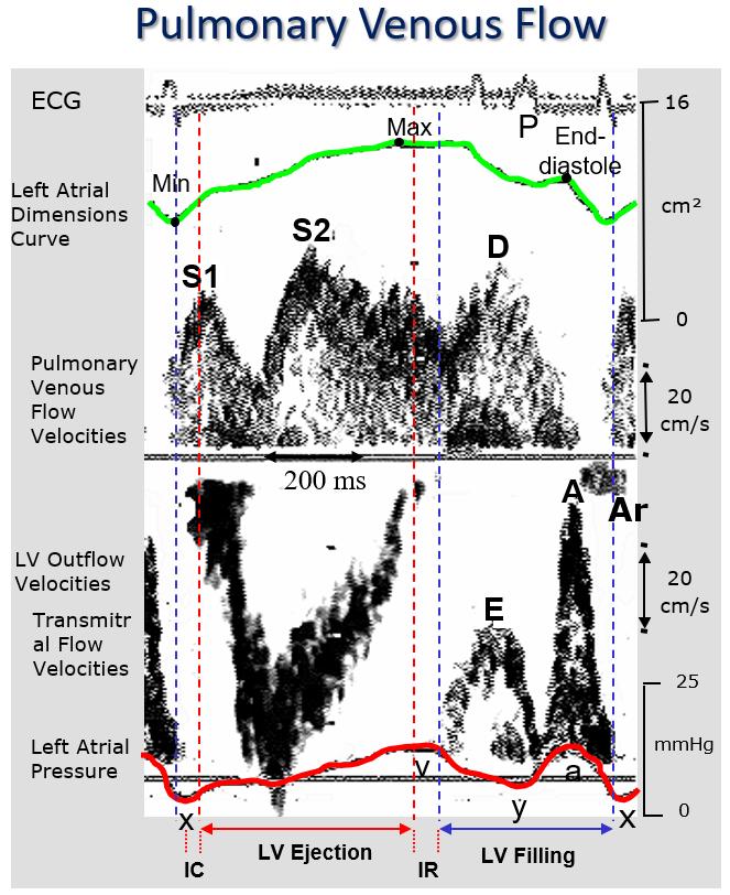 Figure 12 Left atrial physiology. ECG, lefta atrial high-fidelity pressure tracing, pulsed Doppler pulmonary venous and transmitral flow profiles